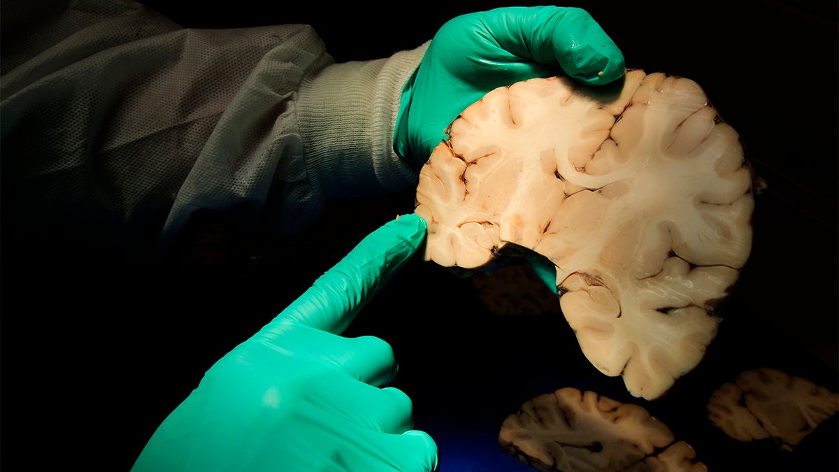 CTE found in 99 percent of former NFL players' brains donated in new study  